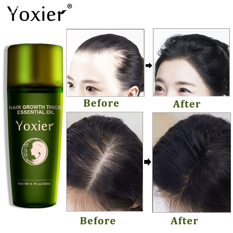 Yoxier Herbal Hair Growth Esse - Hair Care Herbal Products recensione e prezzo